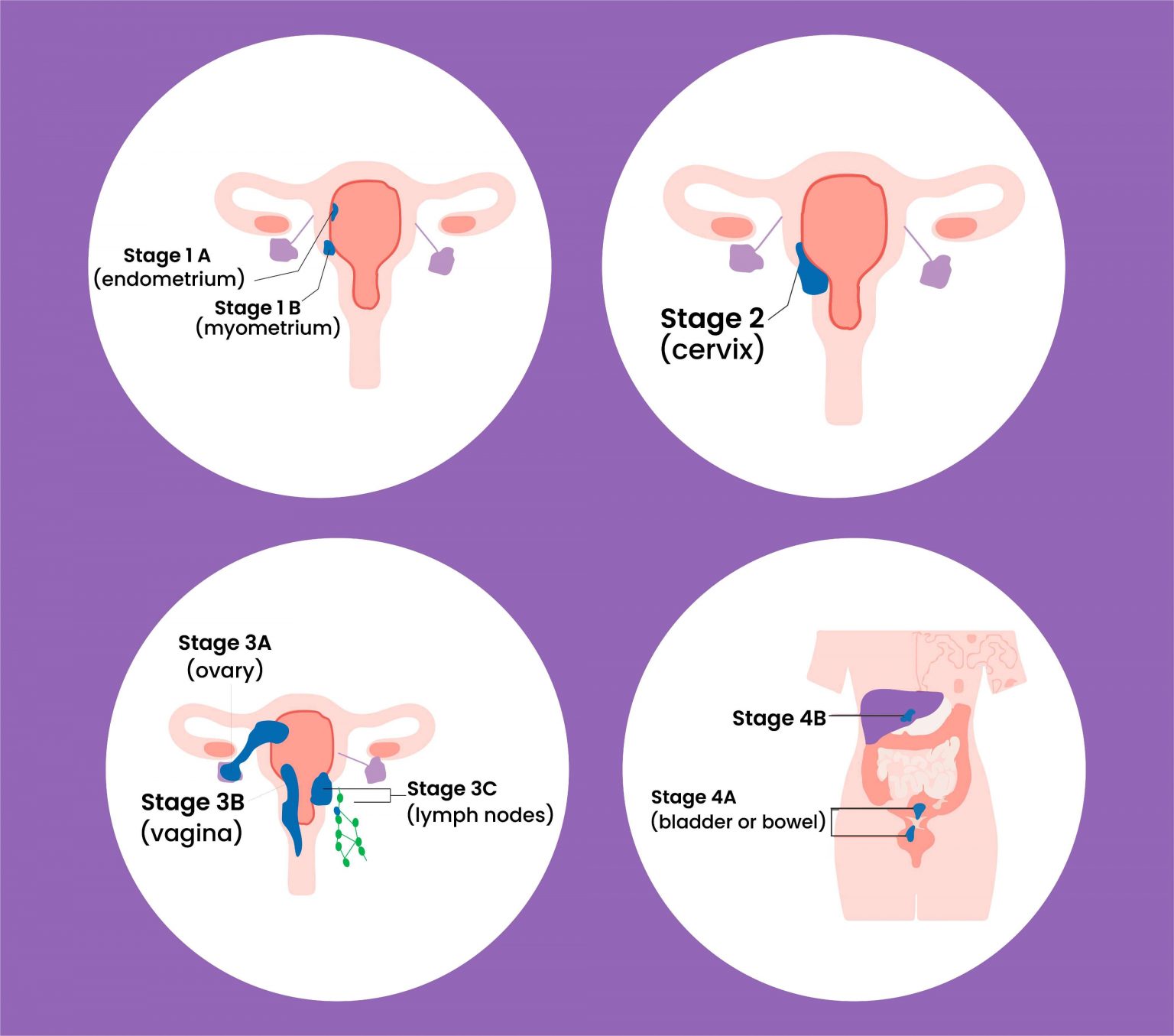 What Is Endometrial Cancer It S Symptoms Stages Etc