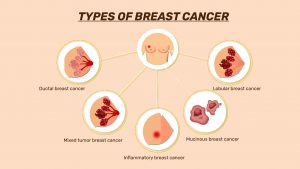 Types of breast cancer