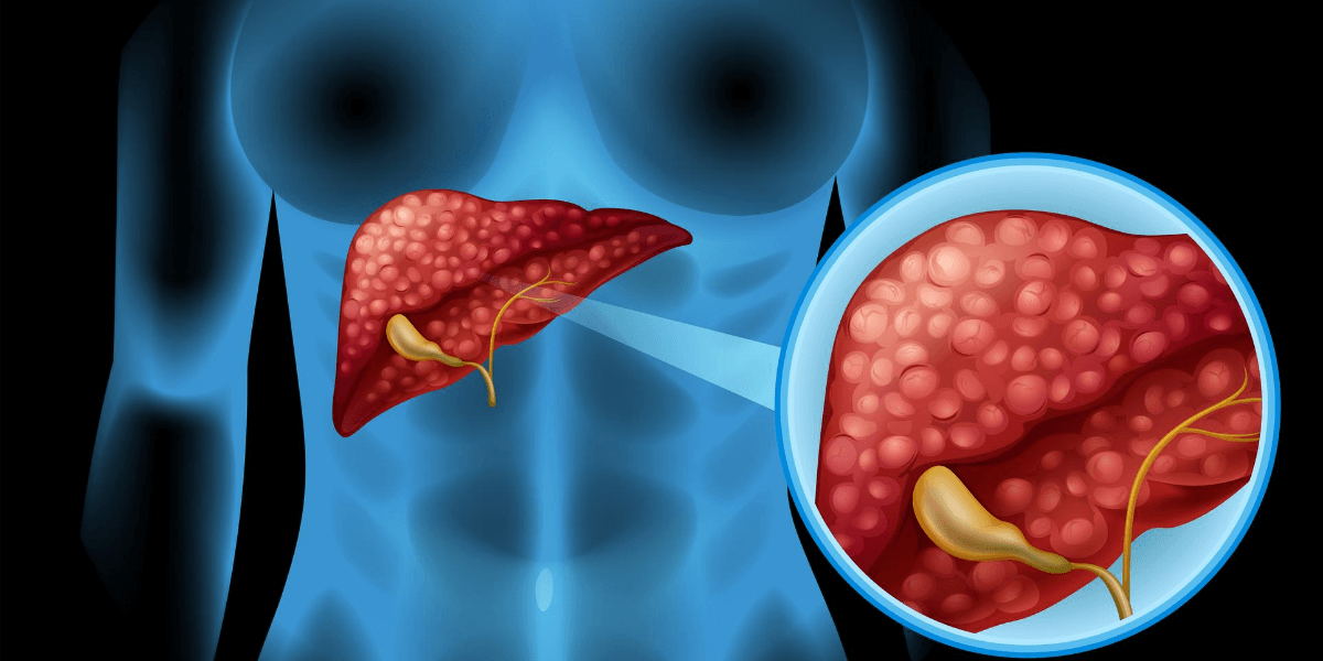 Everything You Must Know About Cholestatic Liver Disease