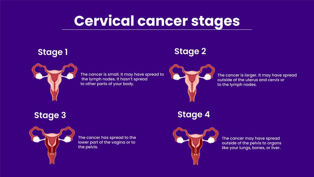 Different Stages Of Cervical Cancer 