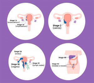 endometrial cancer stages