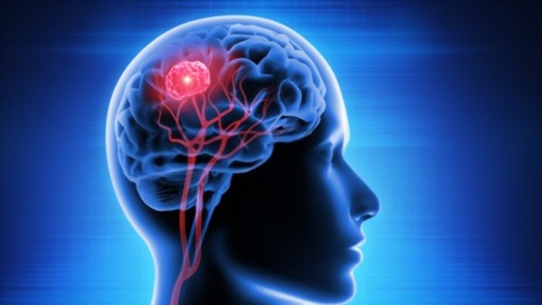 10 Most Common Brain Tumor Symptoms in the Philippines
