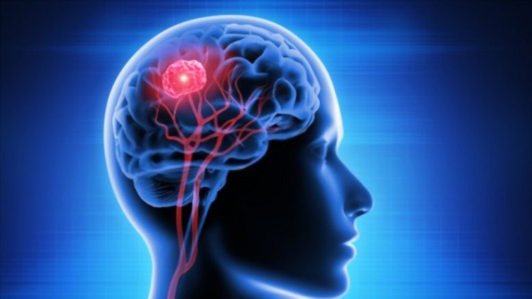 Common Brain Tumor Symptoms in the Philippines