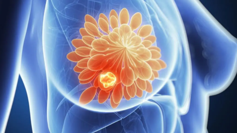 AI PREDICTS BREAST CANCER RISK