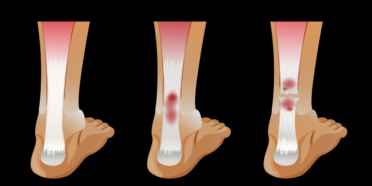 Know More about Bone Marrow Cancer!