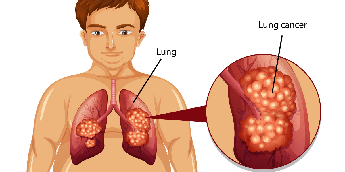Lung Cancer Awareness: Are You at Risk?