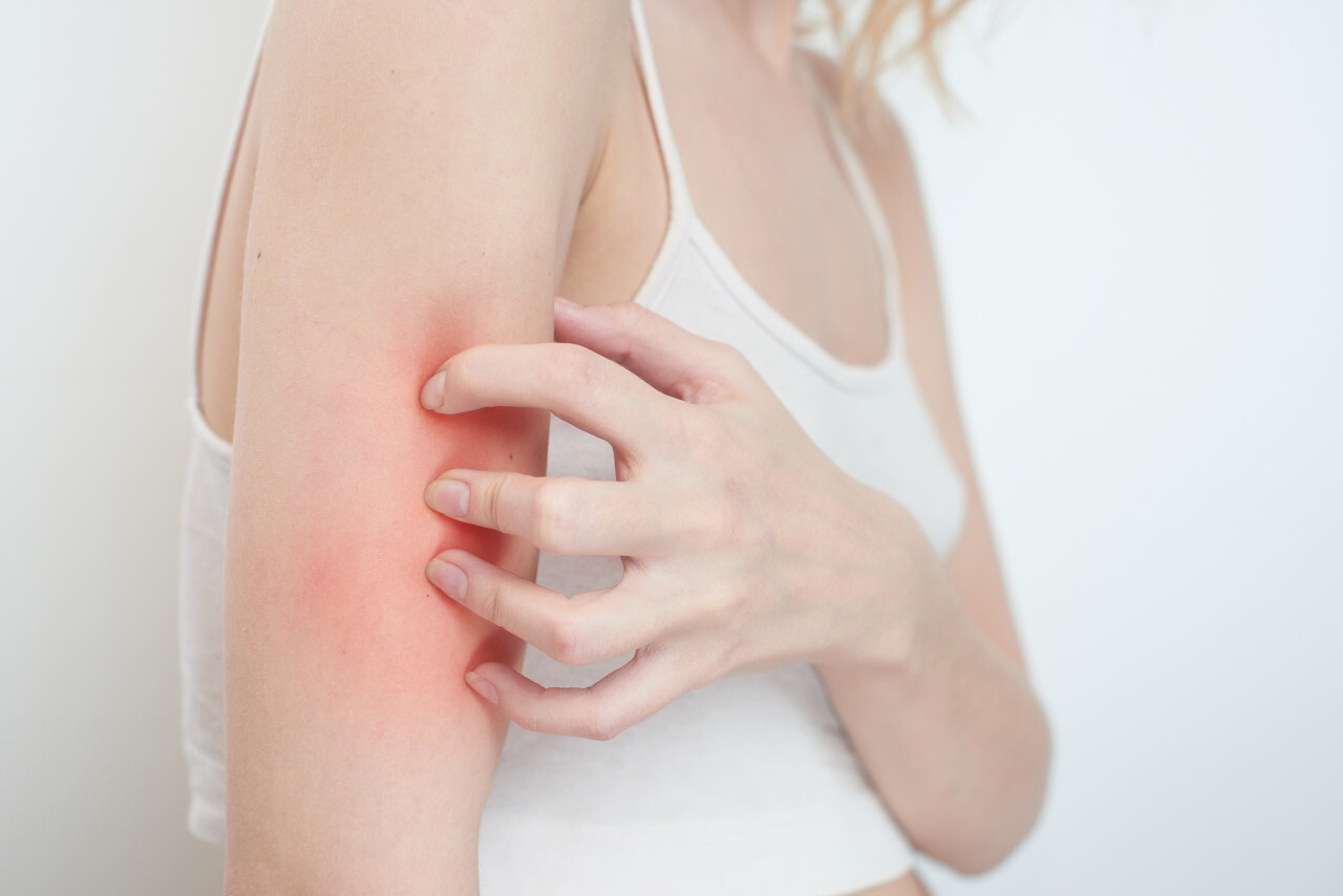 Skin Allergy: Types, Causes, Home Remedies, Treatment And More