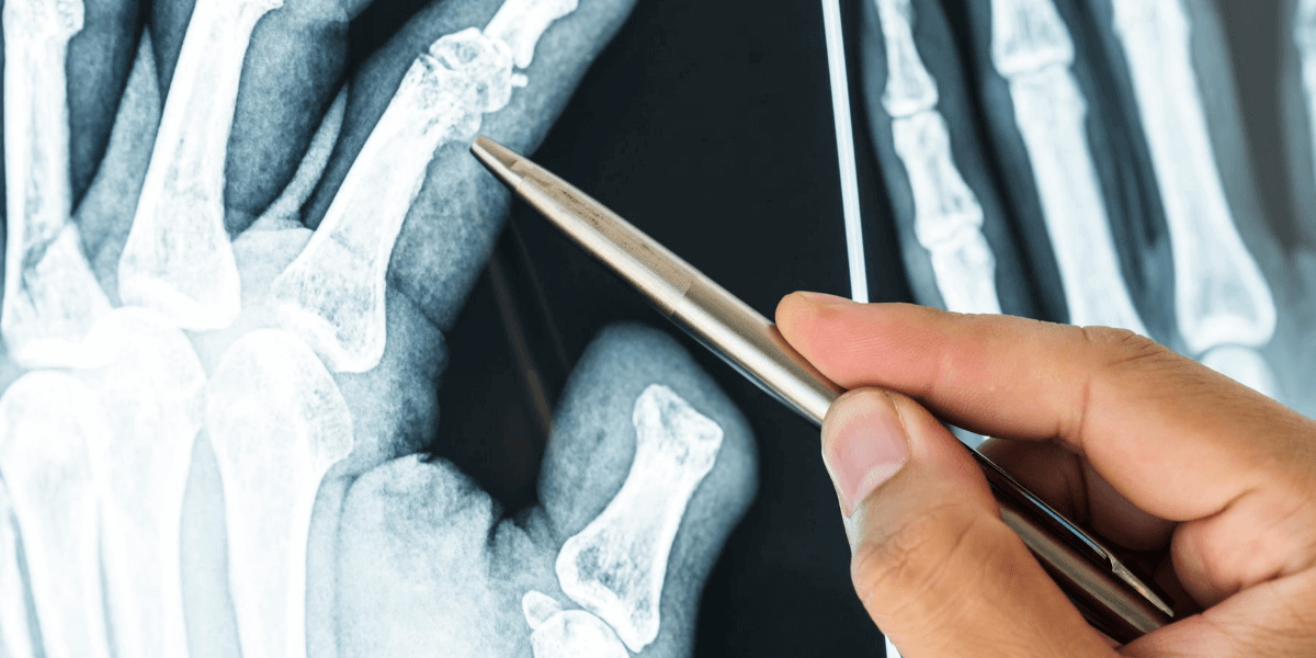Does Diabetes Lead To Tendon Damage