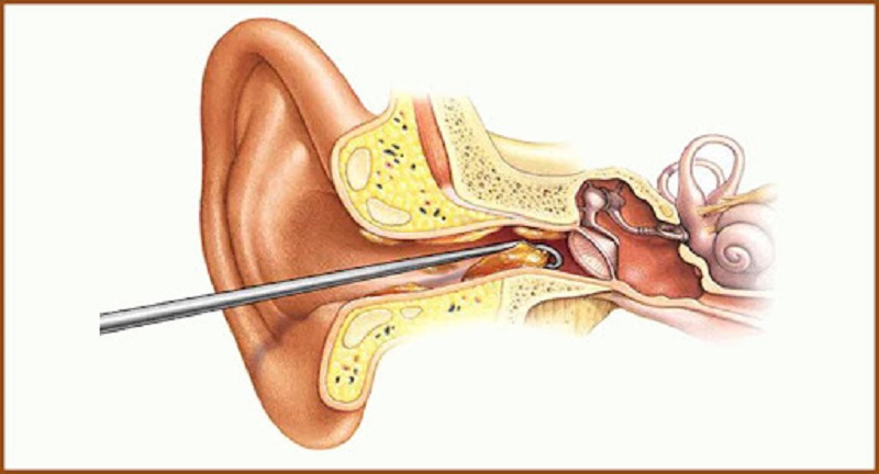 What are the Causes and Symptoms of Ear Wax?
