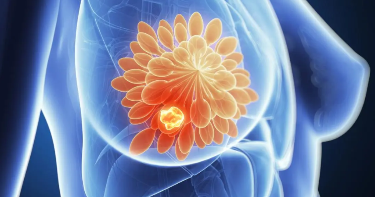 Breakthrough AI Predicts Breast Cancer Risk 6 Years Ahead, Study Reveals
